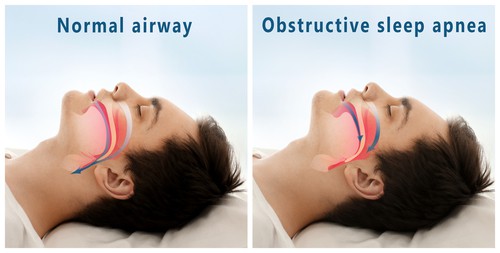 sleep apnea graphic